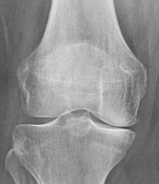Gonartróza a chondropatie – současné možnosti diagnostiky a terapie